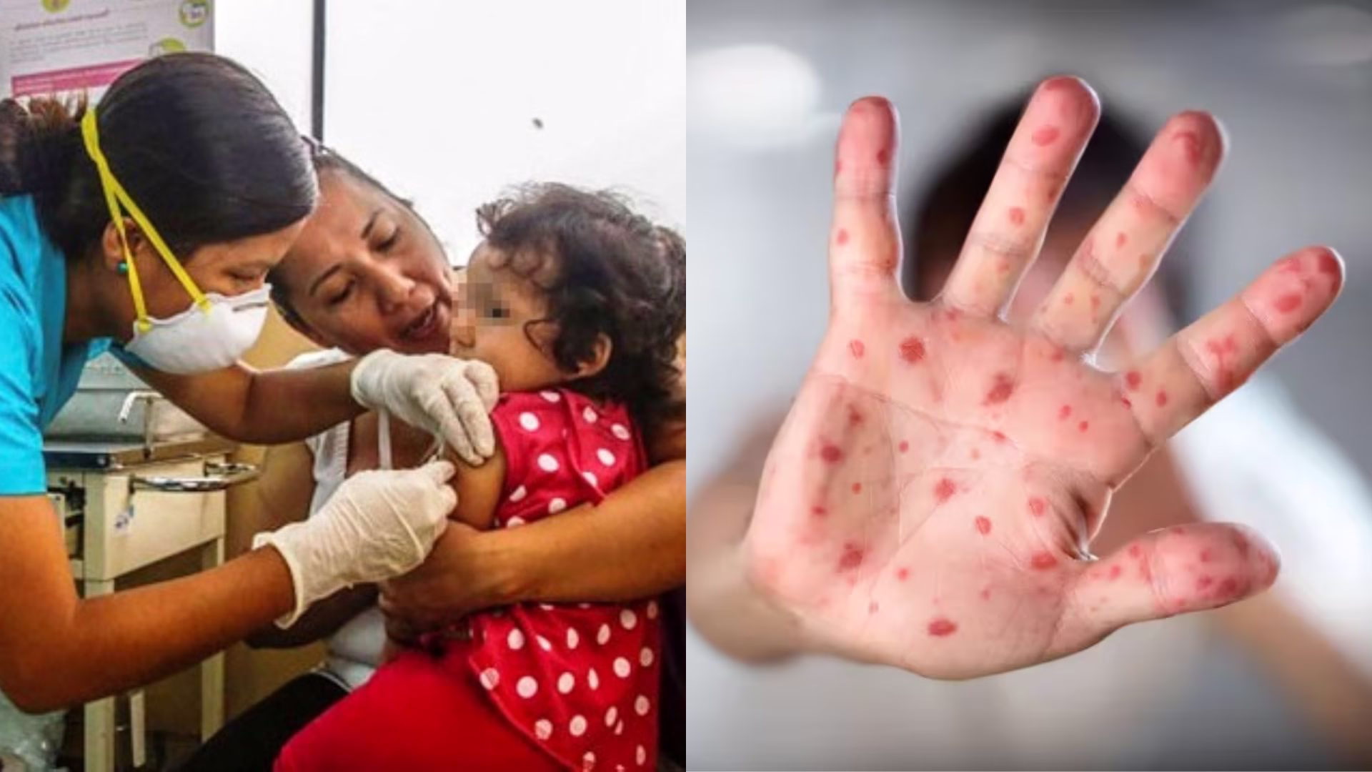 Tacna confirma cuatro casos de sarampión y refuerza el cerco epidemiológico.