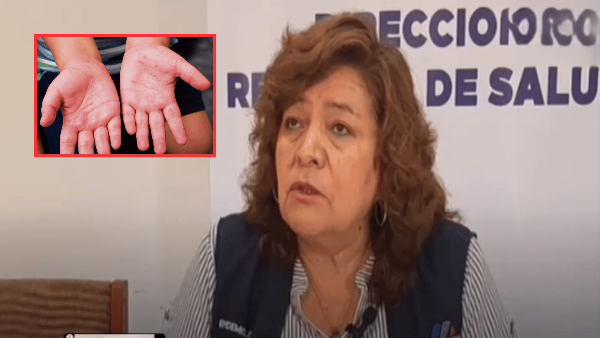Moquegua: Diresa reporta 96 casos de virus Coxsackie y refuerza medidas preventivas.