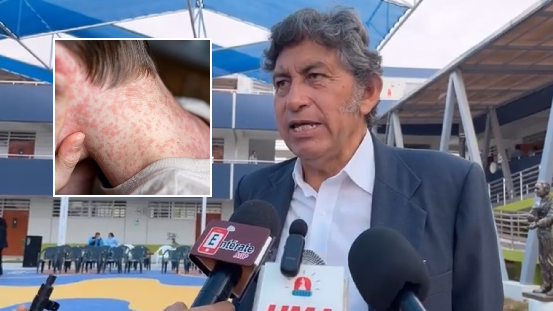 Arequipa confirma dos primeros casos autóctonos de sarampión: pacientes son de Camaná y Miraflores 1 Arequipa confirma dos primeros casos autóctonos de sarampión: pacientes son de Camaná y Miraflores