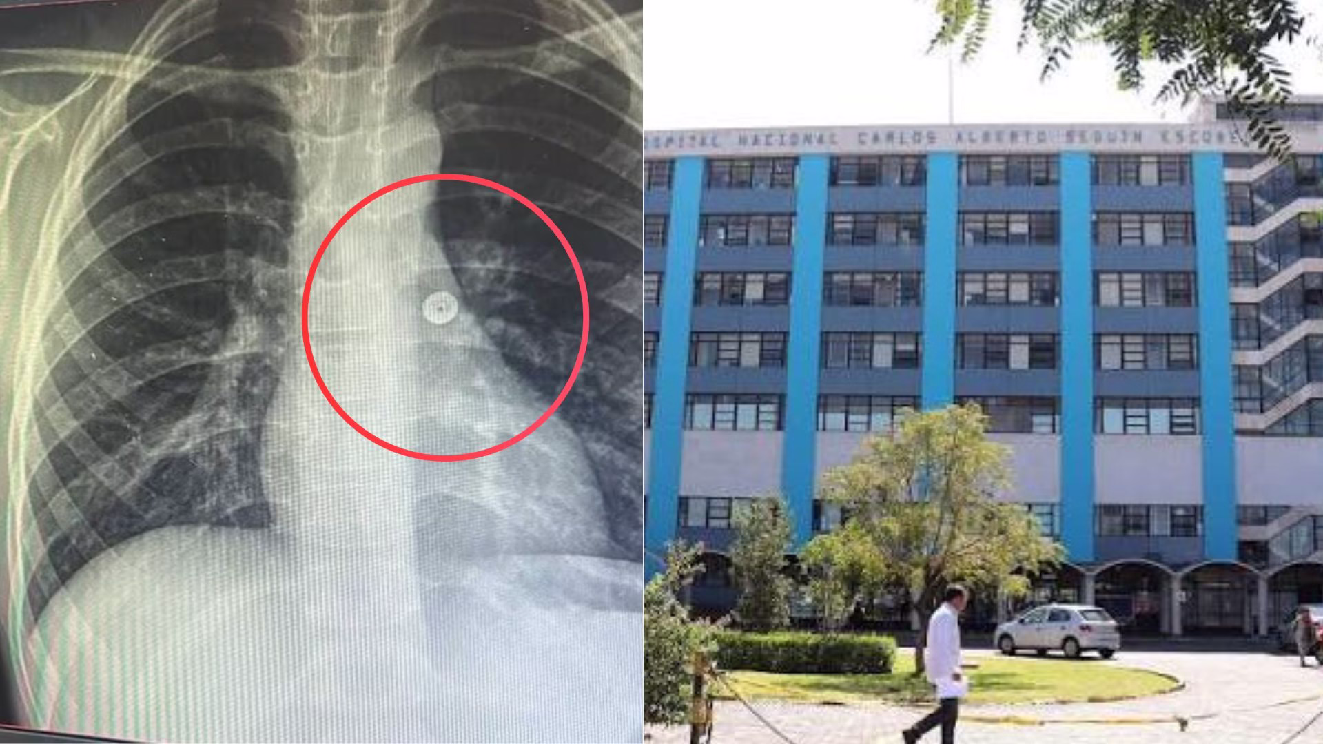 Arequipa: médico de EsSalud extrae chinche metálico del pulmón de un niño de 8 años